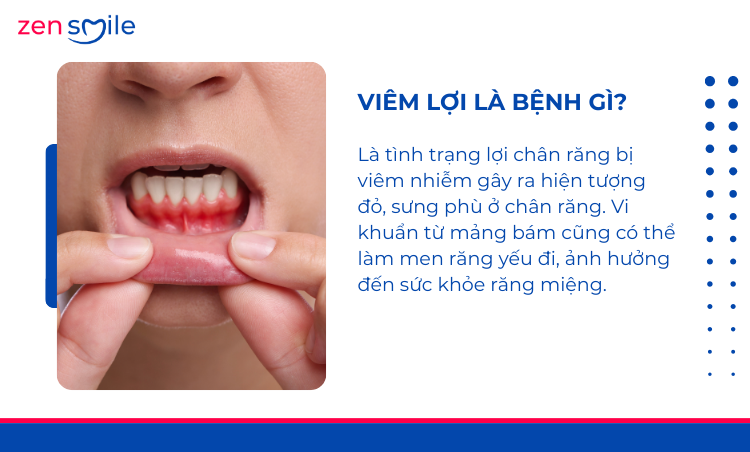 Điều trị viêm lợi mức 1-3 — ảnh 2