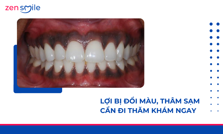 Điều trị nhiễm sắc tố lợi mức 1-3 — ảnh 2