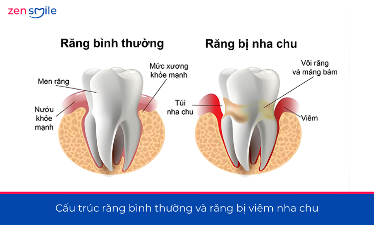 Điều trị nha chu có lật vạt — ảnh 2