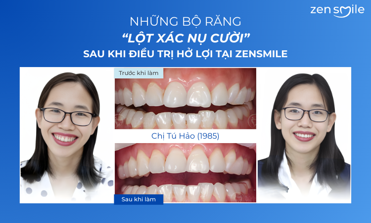 Ca trước – sau tại Nha khoa Zensmile 1