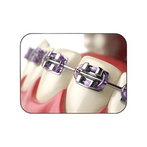 Mắc cài kim loại truyền thống