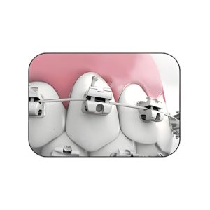 Mắc cài Smart kim loại