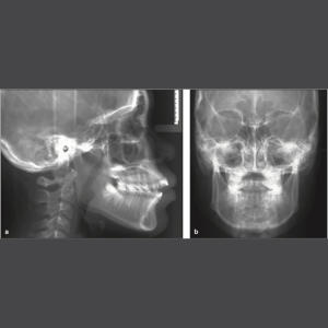 Chụp 2D Cephalometric