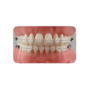 Mắc cài sứ truyền thống