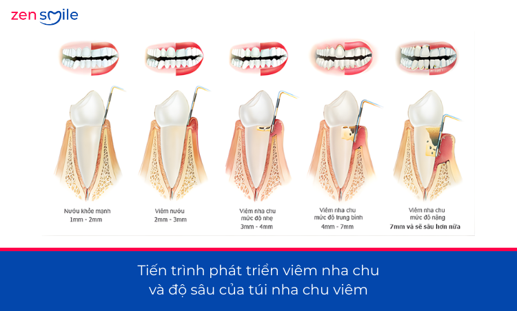Điều trị nha chu có lật vạt — ảnh 3