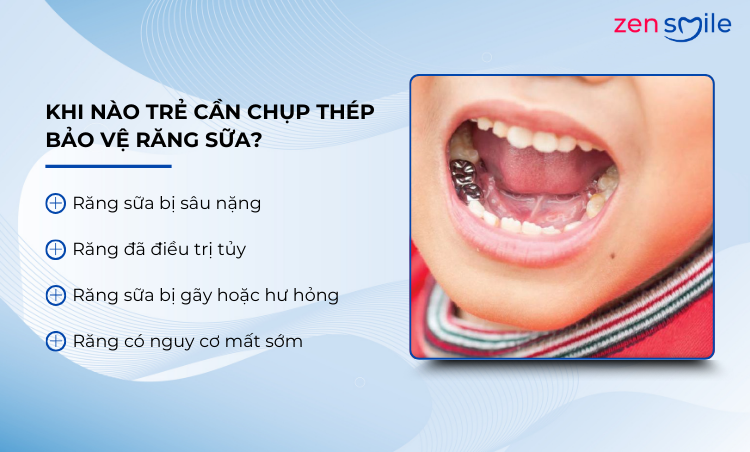 Chụp thép bảo vệ răng sữa trẻ em — ảnh 3