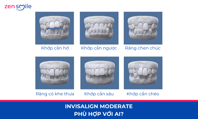 Invisalign Moderate mức 4 — ảnh 4