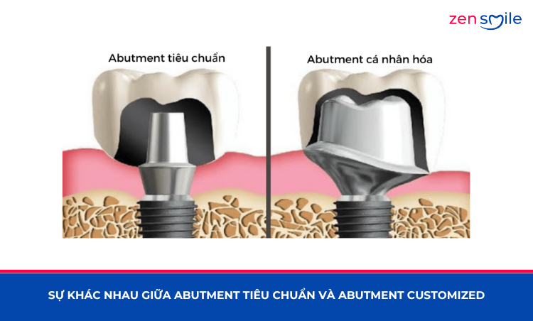 Abutment Customized Sứ (Korea) — ảnh 6