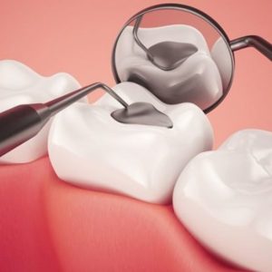 Hàn răng vĩnh viễn (độ 1 – độ 3)