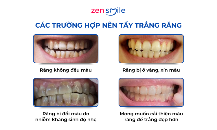 Tẩy trắng răng tại nhà — ảnh 4