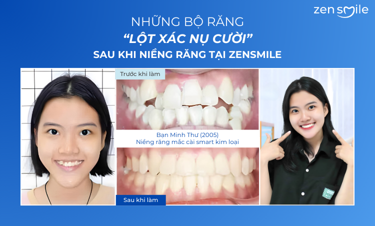 Ca trước – sau tại Nha khoa Zensmile 5