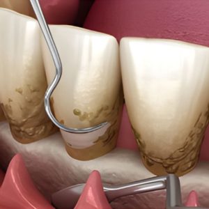 Điều trị nha chu có lật vạt