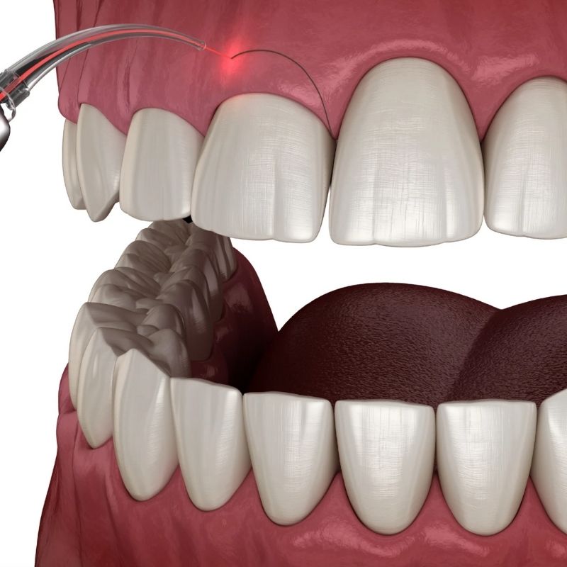 Điều trị hở lợi độ 1-3 — ảnh 1
