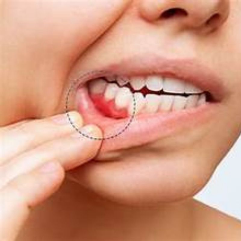Điều trị viêm lợi mức 1-3 — ảnh 1