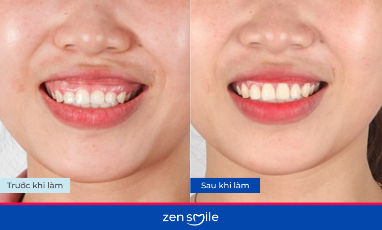 Điều trị hở lợi độ 1-3 — ảnh 2