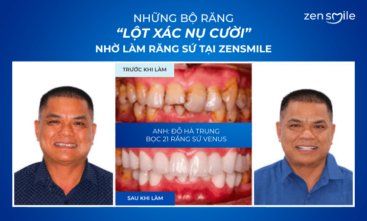 Ca trước – sau tại Nha khoa Zensmile 2