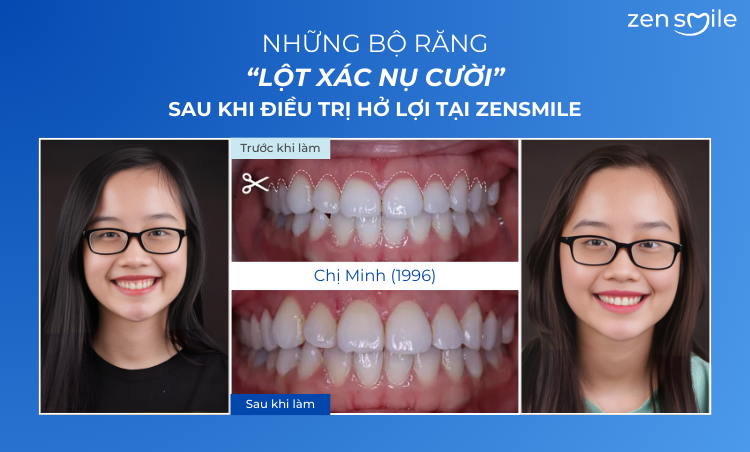 Ca trước – sau tại Nha khoa Zensmile 5