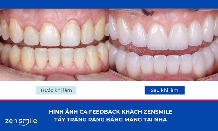 Tẩy trắng răng tại nhà — ảnh 5