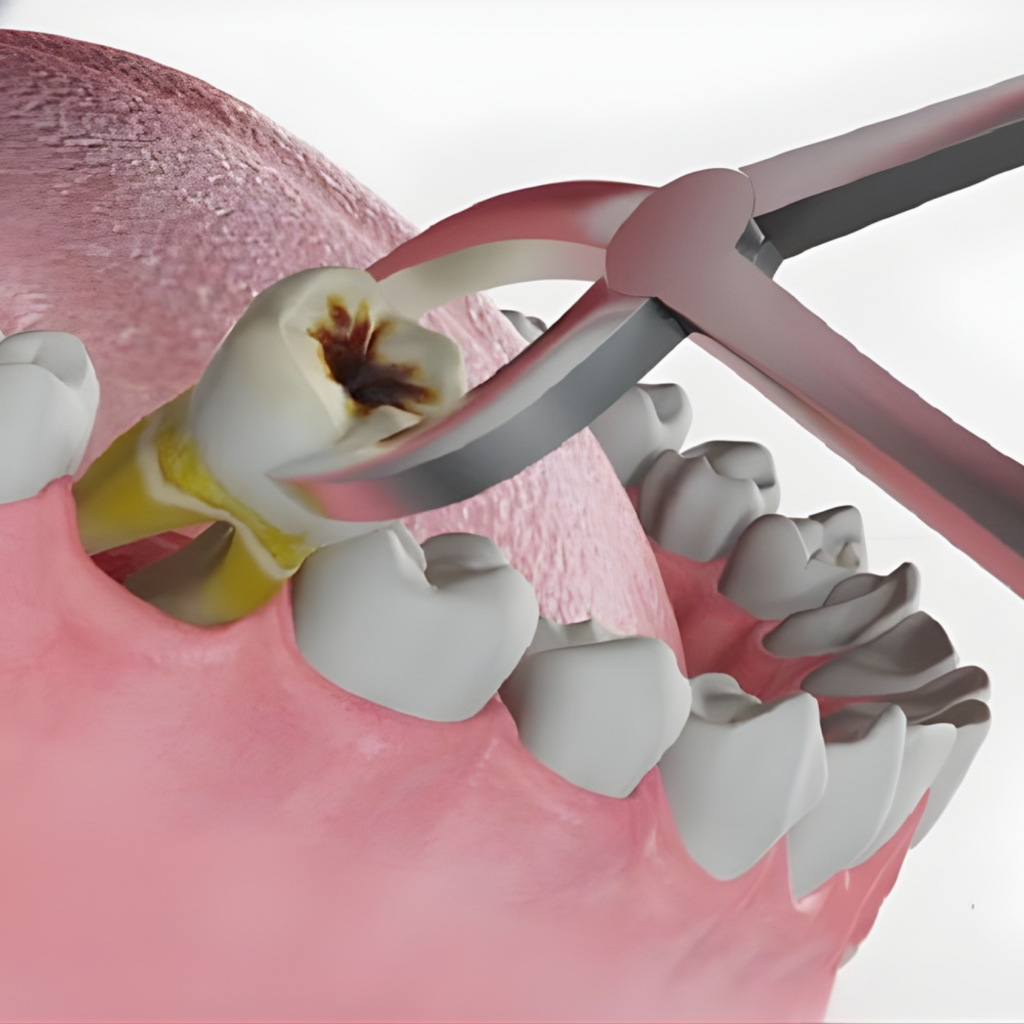 Nhổ răng lung lay — ảnh 1