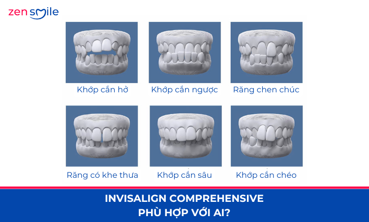 Invisalign Comprehensive mức 5 — ảnh 4