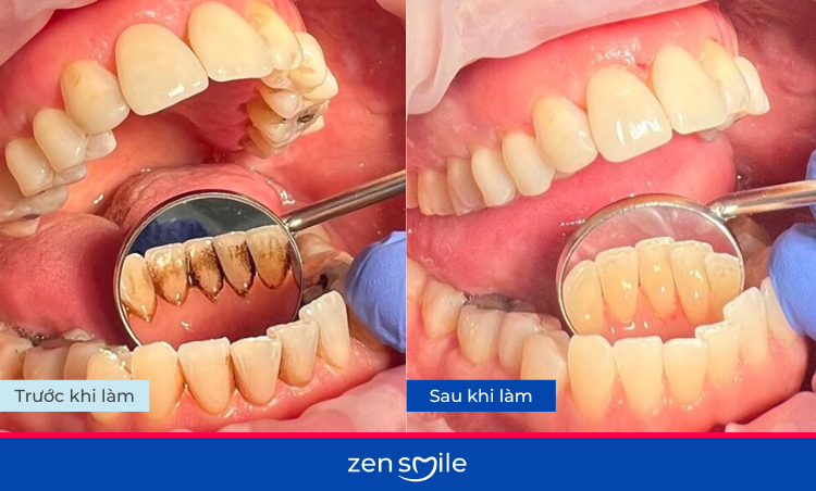 Đánh bóng răng — ảnh 5