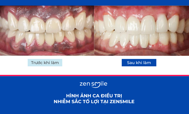 Điều trị nhiễm sắc tố lợi mức 1-3 — ảnh 5