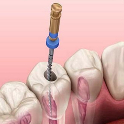 Điều trị tuỷ răng vĩnh viễn 1-4 chân