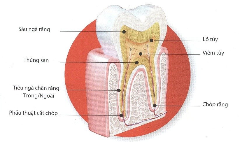 Hàn tuỷ bằng chất hàn sinh học — ảnh 5