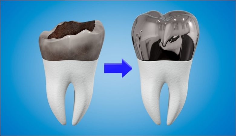 Chụp thép bảo vệ răng sữa trẻ em — ảnh 1