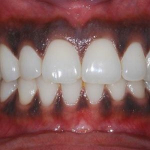 Điều trị nhiễm sắc tố lợi mức 1-3