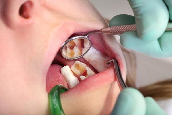 Điều trị tuỷ răng sữa — ảnh 2