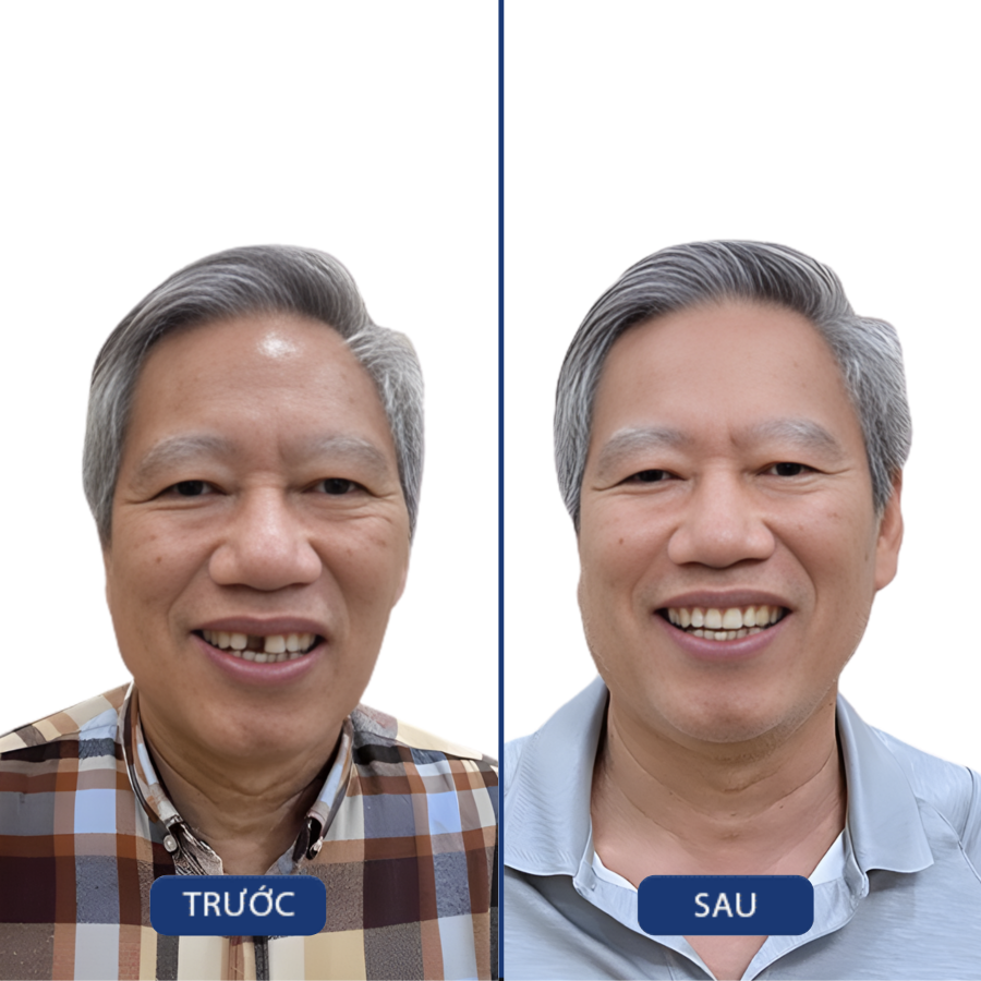Trước và sau Trồng implant — khách hàng Nha khoa Zensmile
