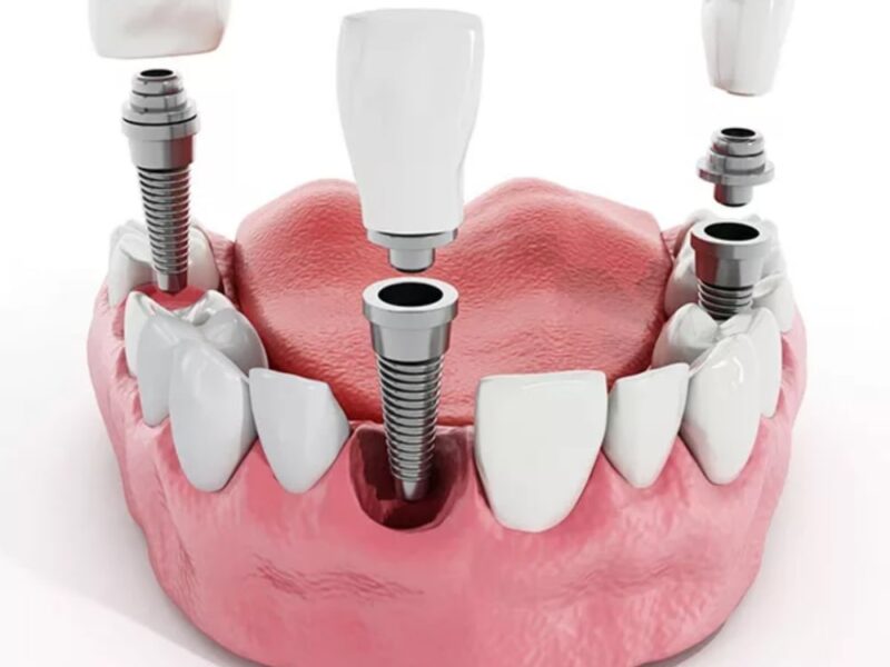 Trồng răng Implant