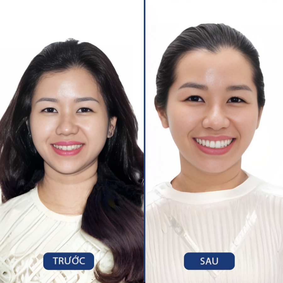 Trước và sau Niềng răng — khách hàng Nha khoa Zensmile