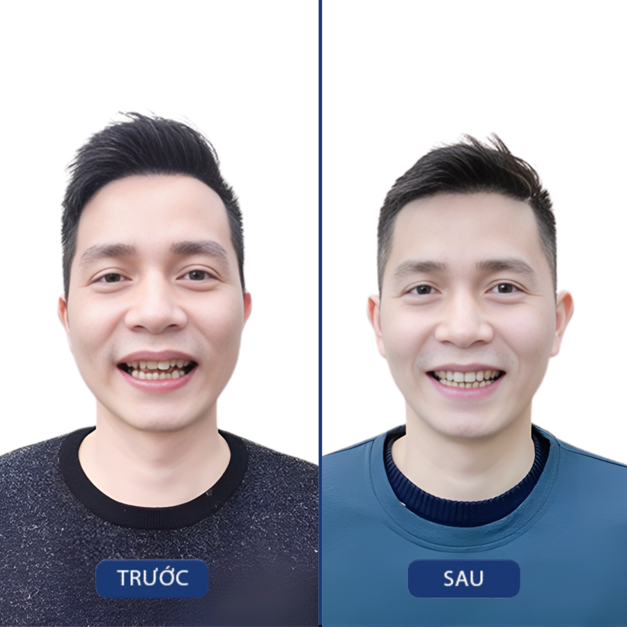 Trước và sau Niềng răng — khách hàng Nha khoa Zensmile
