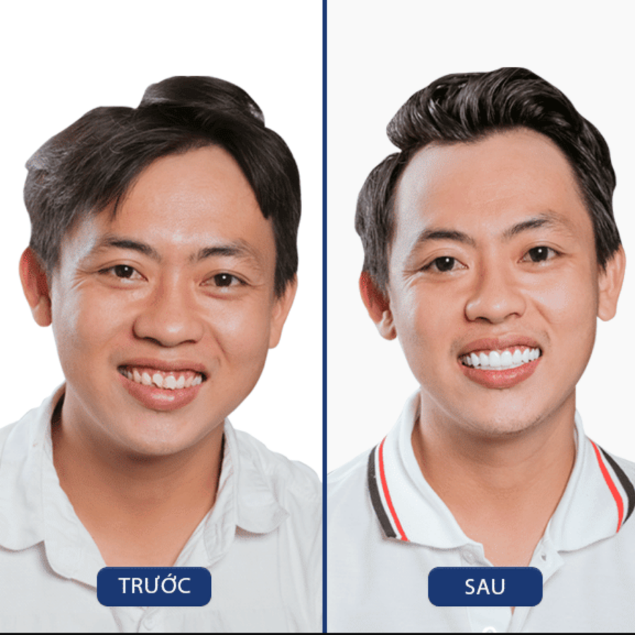 Trước và sau Răng sứ — khách hàng Nha khoa Zensmile