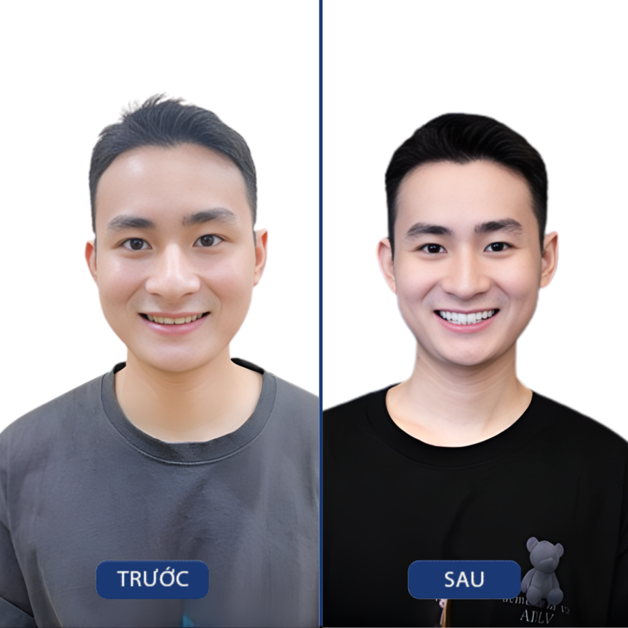 Trước và sau Răng sứ — khách hàng Nha khoa Zensmile